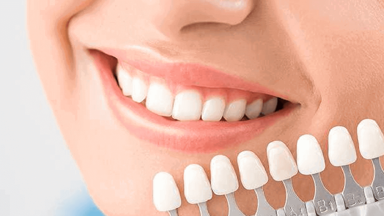 Smiling person showcasing bright white teeth alongside dental shade guide for cosmetic dentistry options.