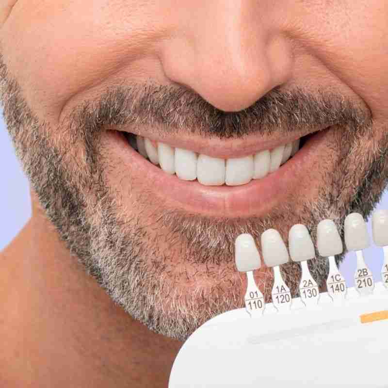 Smiling man showcasing custom ceramic dental crowns against a shade guide, highlighting cosmetic dentistry options at JAX Dental Arts.