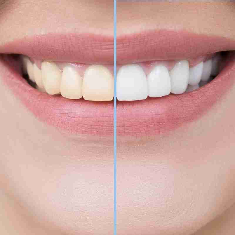 Before and after comparison of teeth whitening results, showcasing a bright, white smile on one side and a yellowed smile on the other, emphasizing the effectiveness of professional teeth whitening services.