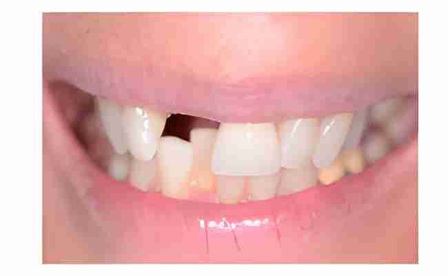 Close-up of a smile showing a gap between the front teeth, highlighting the need for dental implant restoration at JAX Dental Arts.