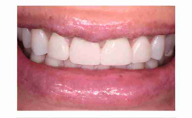 Close-up of a patient’s smile showcasing dental implant restoration results with natural-looking, metal-free ceramic crowns blending seamlessly with surrounding teeth.