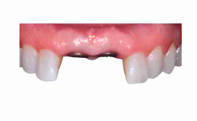 Dental implant restoration site showing gap between front teeth and healthy surrounding gums, illustrating the need for aesthetic and functional implant solutions at JAX Dental Arts.
