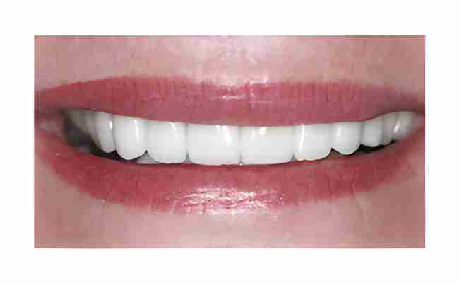 Close-up of a smiling mouth showcasing bright, white teeth, highlighting successful dental implant restoration at JAX Dental Arts.